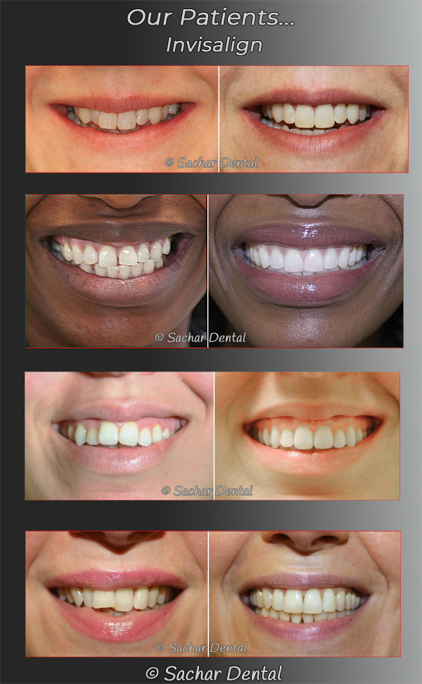 Invisalign NYC Before And After Pictures P02 V01 600 WIDTH 