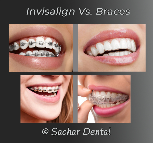 Dentist NYC, Invisalign Vs Metal Braces