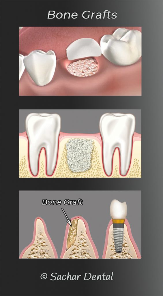 Dental Bone Graft NYC | Manhattan Dental Implant And Bone Graft