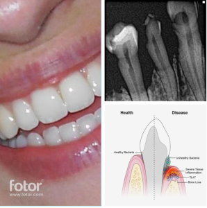 Periodontal Treatment including LANAP Procedure in NYC