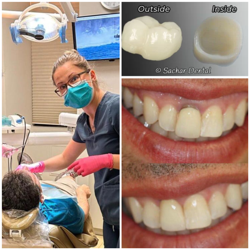 Patient receiving a dental crown procedure at NYC Dentist, Sachar Dental