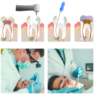 Dentist NYC for Root Canal Treatment