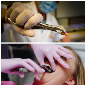Tooth Extraction NYC