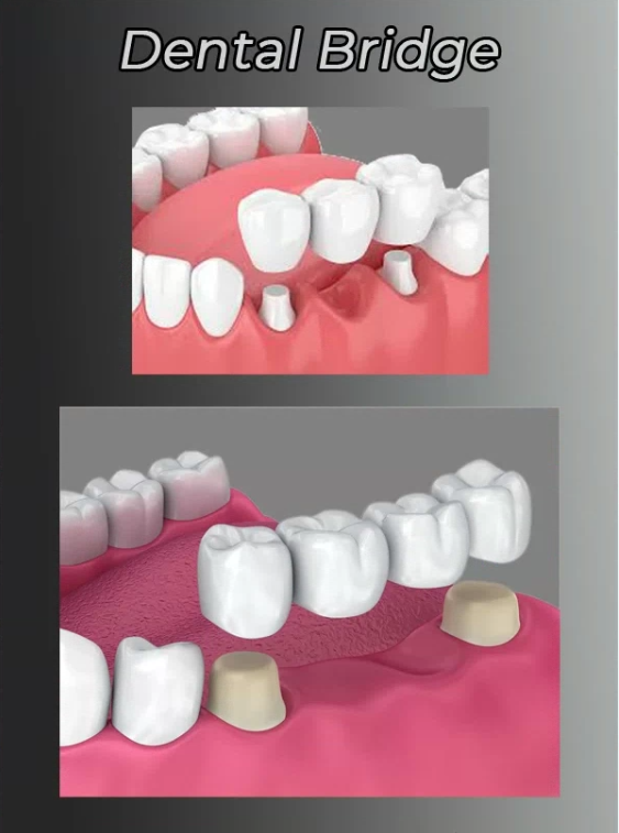 Illustration of a Dental Bridge