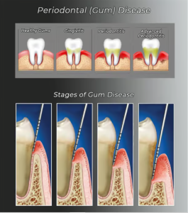 Illustration showing the stages of gum disease, from healthy gums to advanced periodontitis.