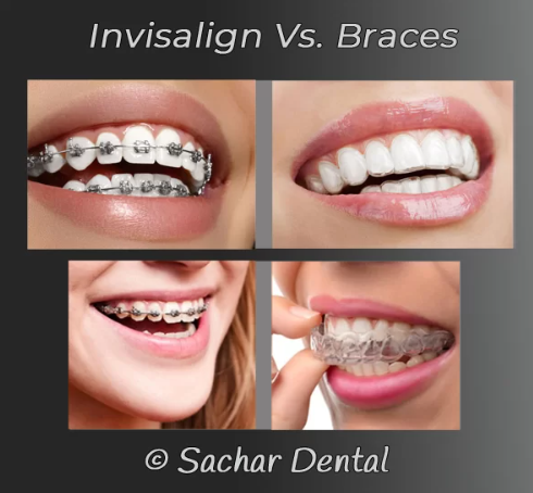 Invisalign vs. Braces