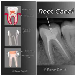 Images of a tooth with root canal treatment and an X-ray showing the treated tooth