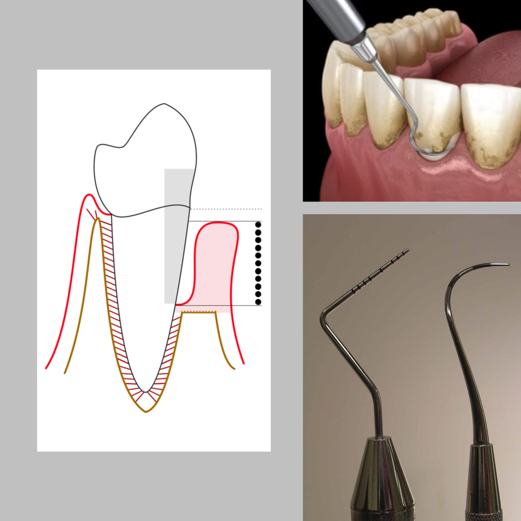 Periodontitis Treatment NYC: Collage of gum disease comparison, scaling and root planing, and dental instruments