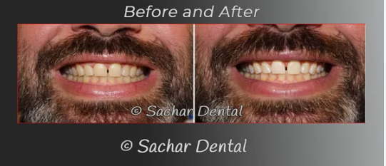 Before and after images showing the results of teeth whitening treatment, with NYC dentist, Dr Sachar, highlighting a significant improvement in tooth whiteness and brightness.