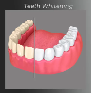 Jaw with half discolored and half whitened teeth, showing the difference.