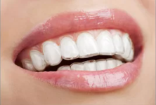 Smiling while wearing Invisalign aligners