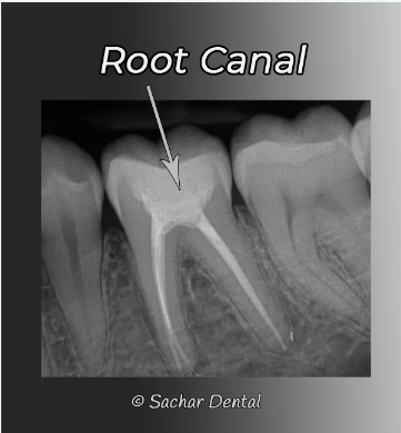 NYC Dentist Root Canal Radiograph