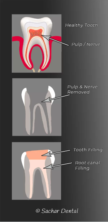 Best NYC dentist for Root Canal Treatment