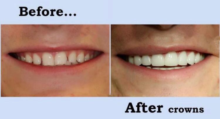 Before and After Dental Crowns