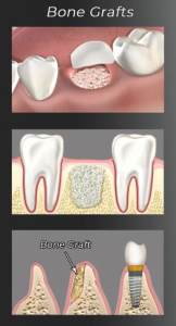 Dental bone graft procedure showing bone material being placed in the jaw for future dental implant support.