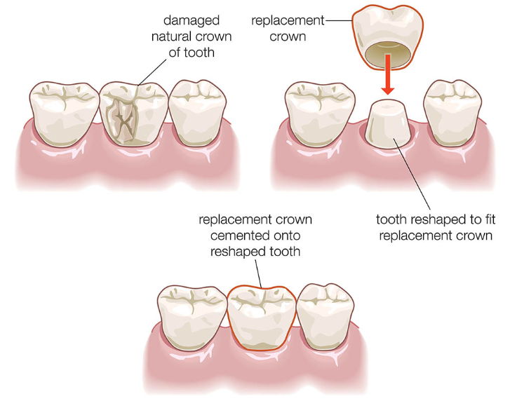 Dental Crowns NYC used to cover a broken or decayed tooth.