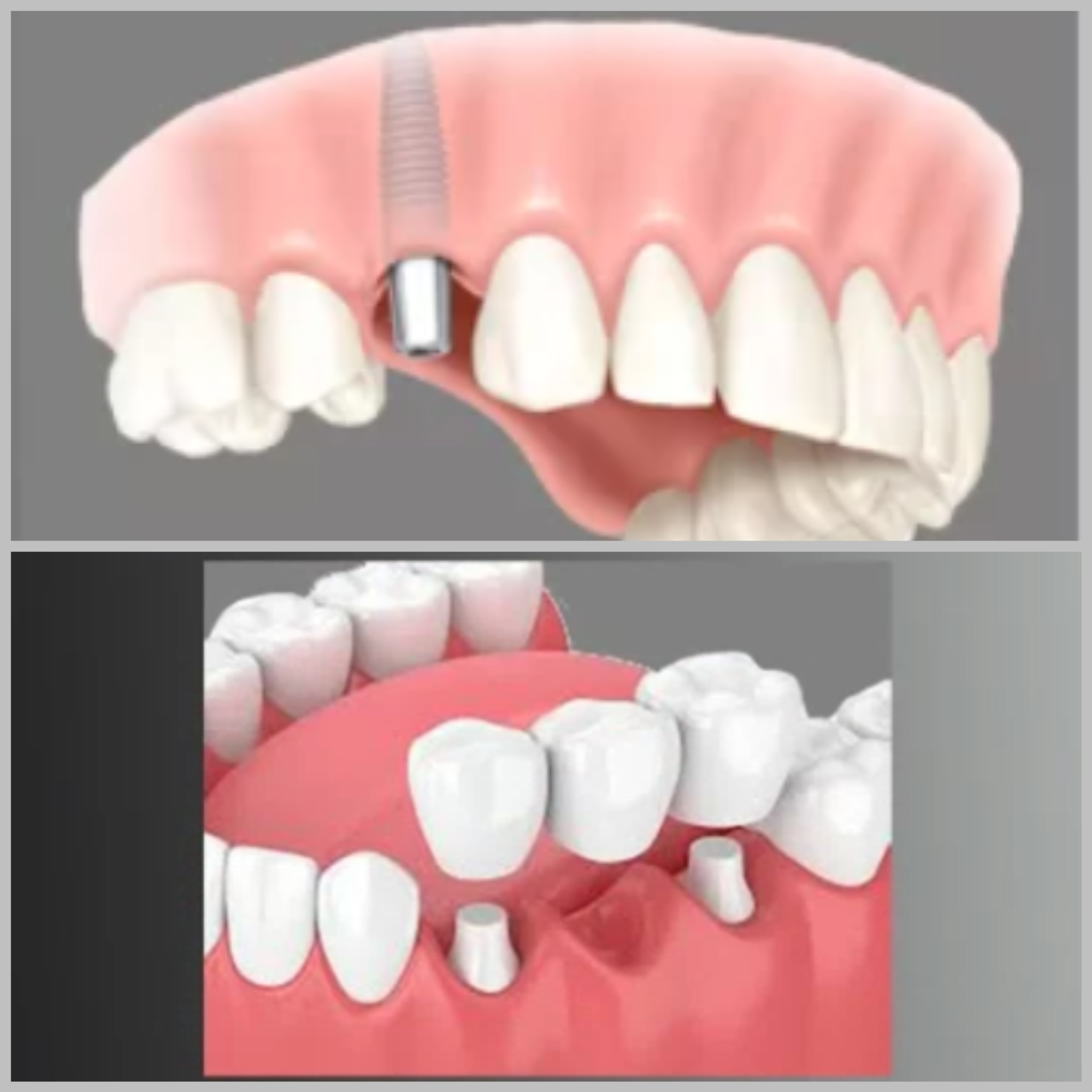 Dental implant and dental bridge options as alternatives to the best dentures in NYC.