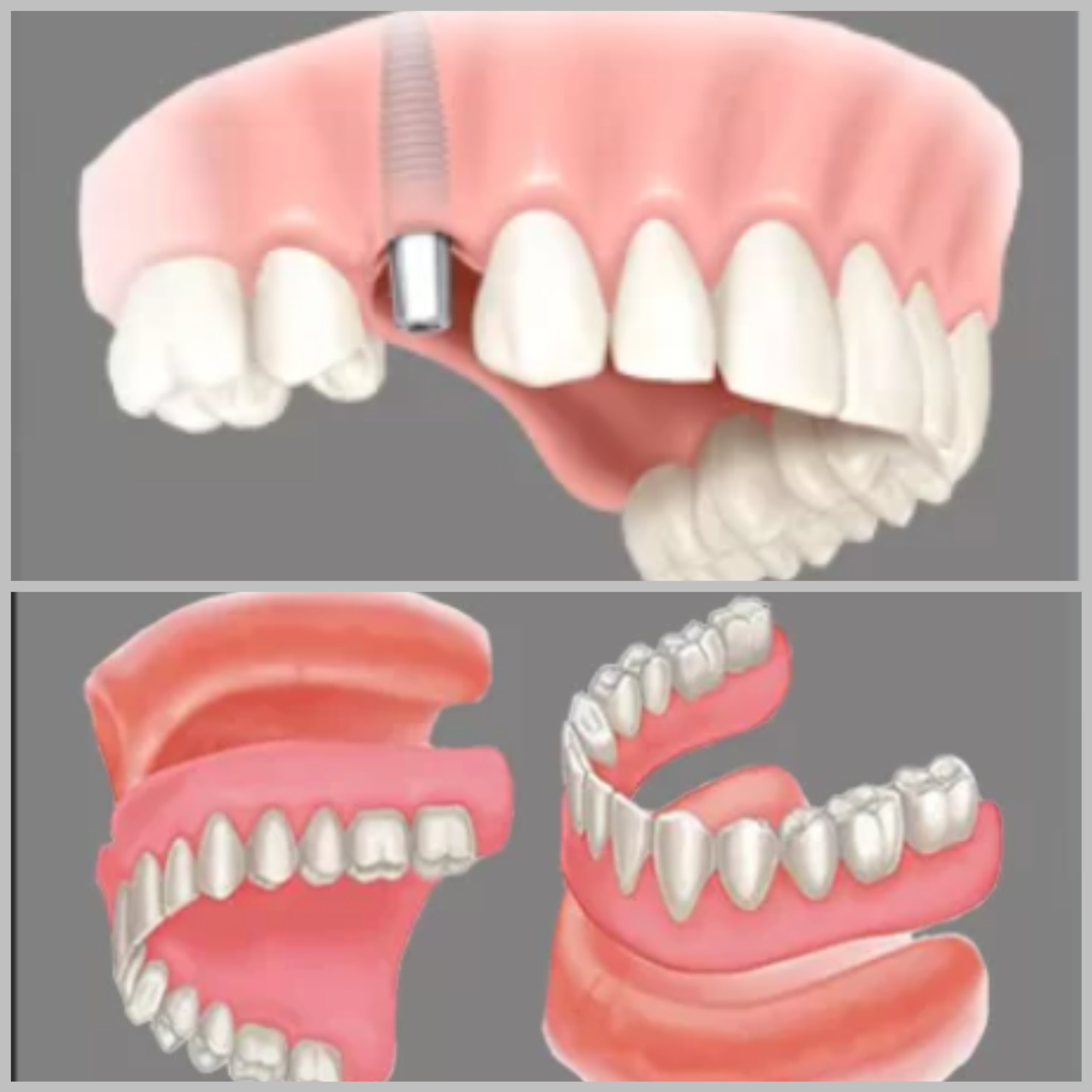 Dental Implant vs. Dentures