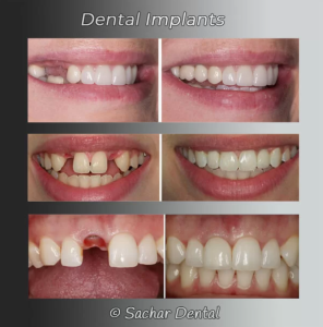 Before and After Dental Implants