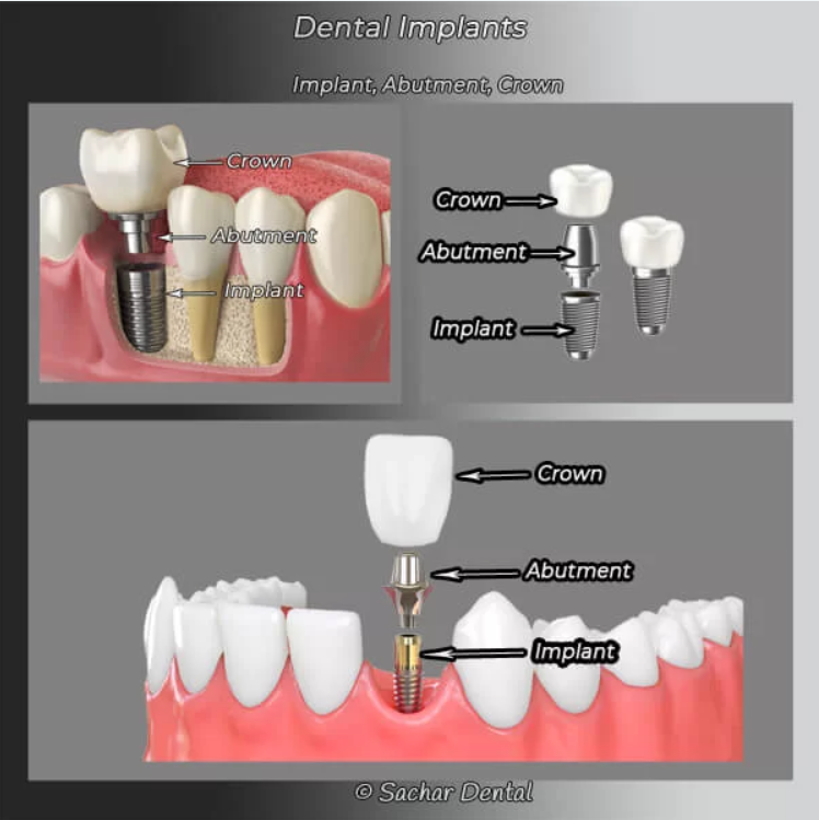 Components of Dental Implants: Post, Abutment, and Crown