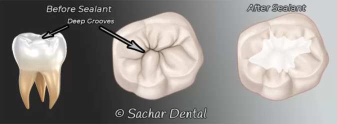 Dental Sealants NYC