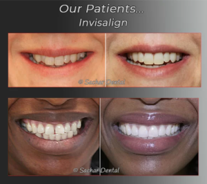 Before and after images of a patient's smile transformation using Invisalign treatment, showing aligned teeth and improved aesthetics