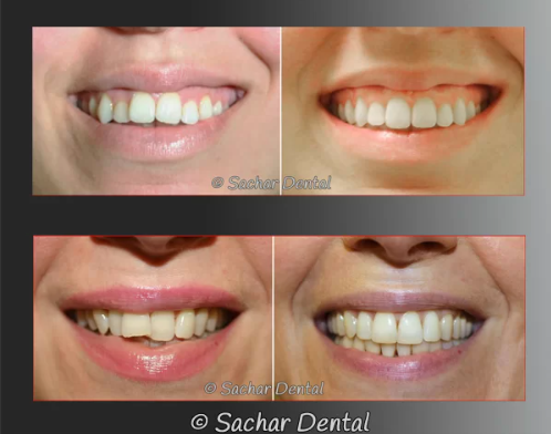 Before and after images of a patient's smile transformation using Invisalign treatment, showing aligned teeth and improved aesthetics