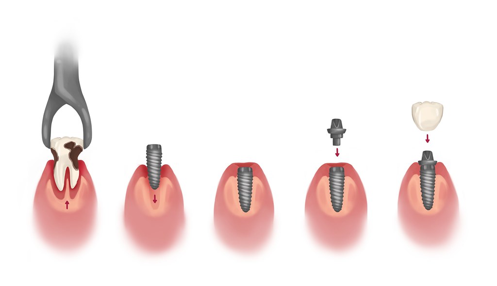 Best dental implants NYC step-by-step process