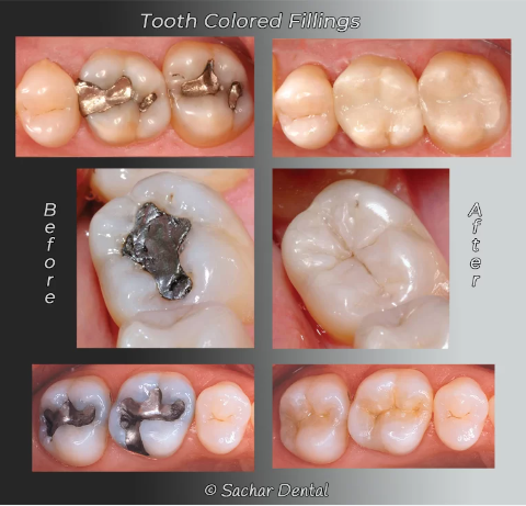 Tooth-Colored Fillings in NYC: Before and After Transformation