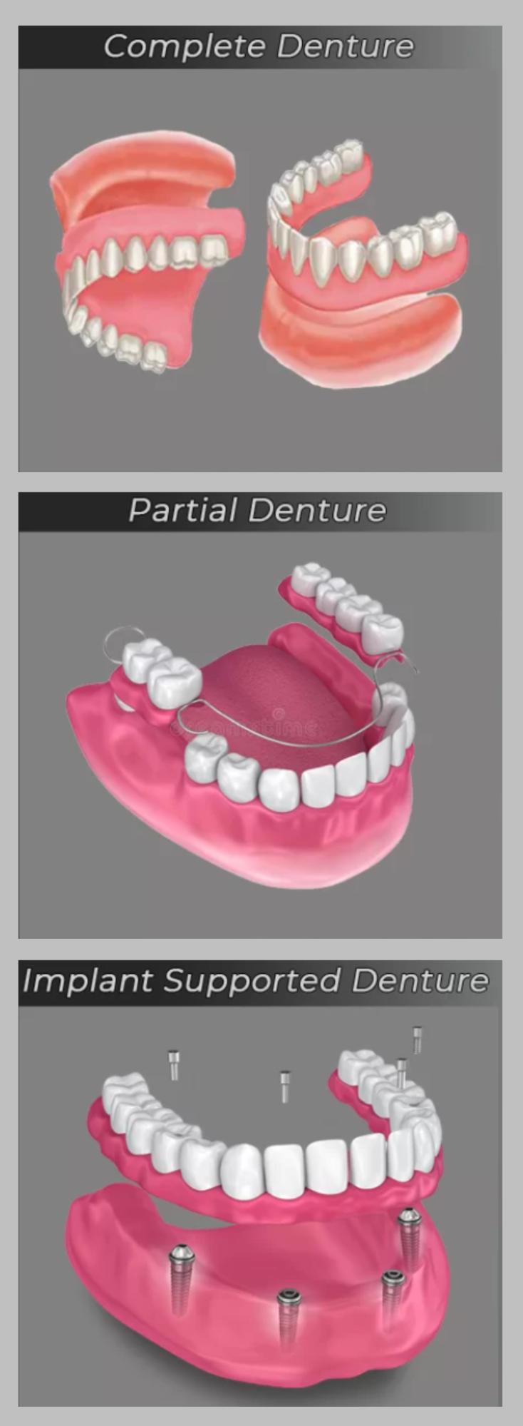 Various types of the best dentures in NYC, including full, partial, and implant-supported dentures.