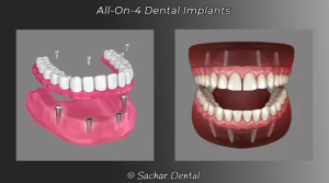 All-on-4 Dental Implants vs Dentures