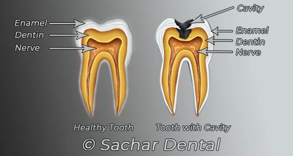 Dental fillings NYC: healthy tooth vs. tooth with cavity