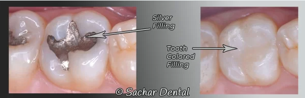 Before and After Fillings