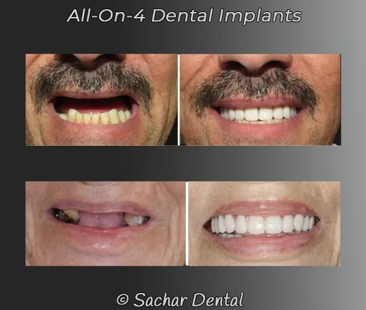 Before and after images of patients who received All-on-4 dental implants, illustrating the dramatic transformation in their smile and dental health.