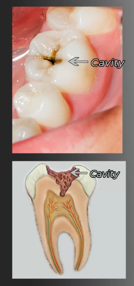 Tooth with a cavity