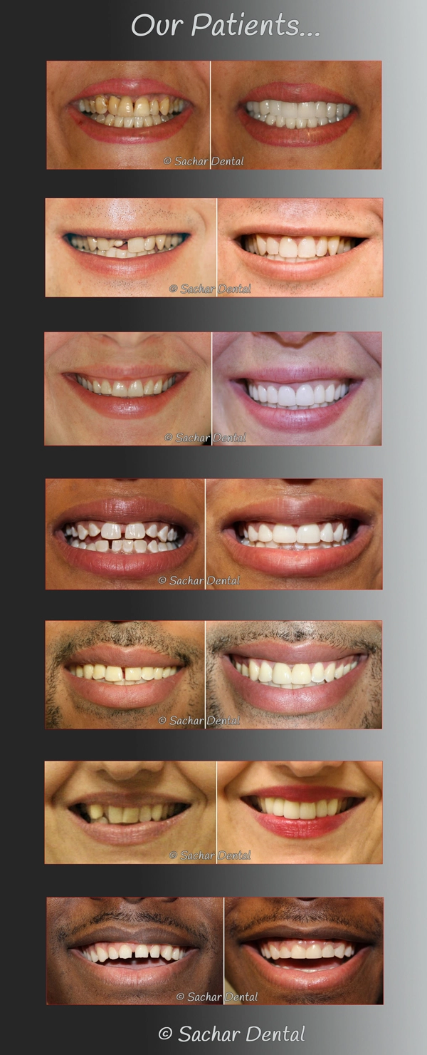 Smile makeover NYC - Best Cosmetic Dentist NYC - Before ( After Pictures