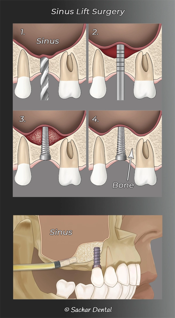 New York City top periodontists for sinus lift surgery and dental implants