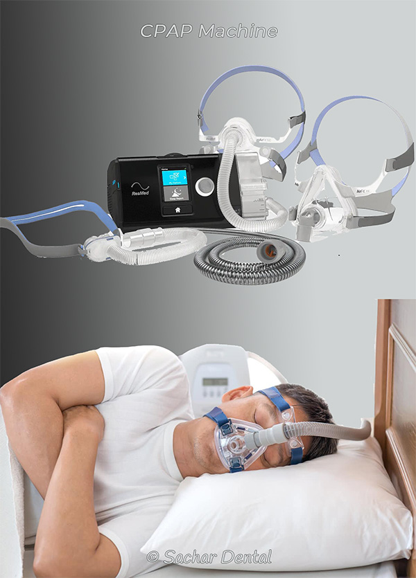 CPAP Alternative oral appliance P01 V01 W600