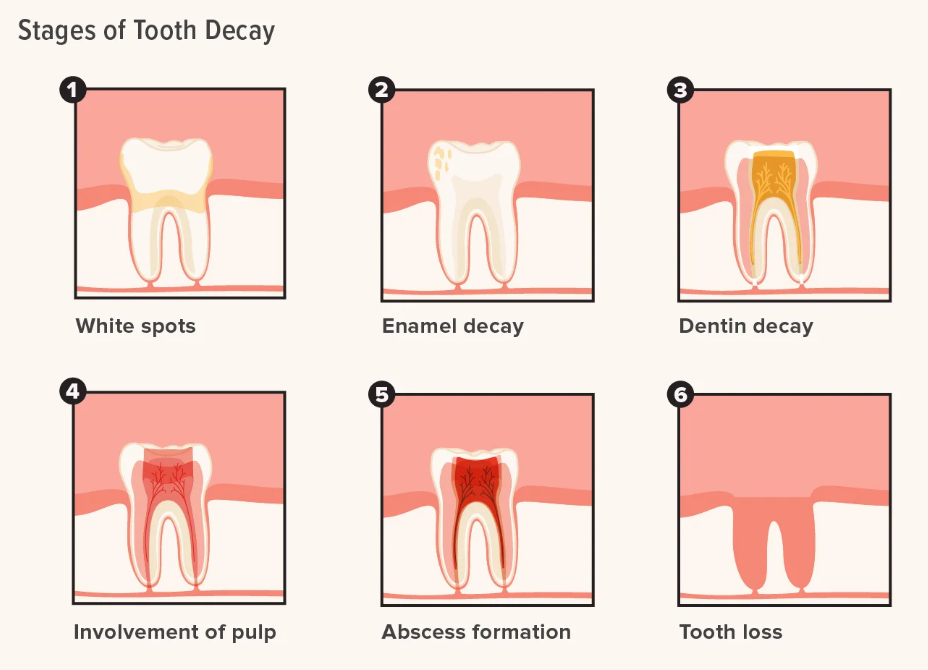 Tooth Decay in America