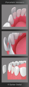 Step-by-step 3D illustration of porcelain veneer application, showing how to avoid fake looking veneers with precise techniques.