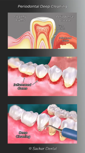 Dental Deep Cleaning in NYC – Tooth scaling and root planing procedure to remove plaque, tartar, and promote healthy gums.