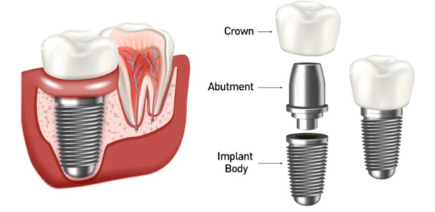 Diagram of dental implants showing the implant body, abutment, and crown as components of a complete dental implant system.