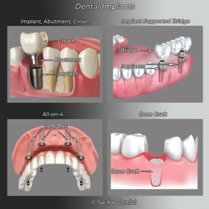 Illustration of dental implants, including implant-supported bridge, All-on-4 implants, and bone graft procedures.