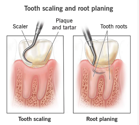 Dental Deep Cleaning in NYC – Tooth scaling and root planing procedure to remove plaque, tartar, and promote healthy gums.