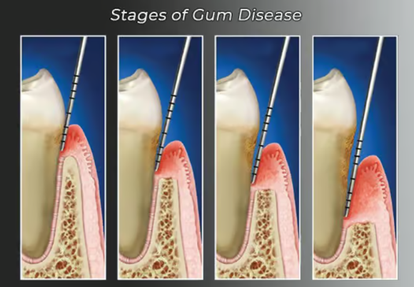 Illustration showing the stages of gum disease, from healthy gums to advanced gum disease with bleeding gums and infection.