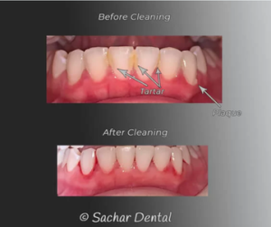 Comparison of tartar vs. plaque on teeth before and after professional dental cleaning