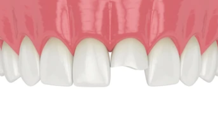 A detailed image showing a chipped tooth, highlighting the damage to the enamel.