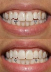 Before and after images of dental bonding treatment, showcasing the improvement of tooth gaps and shape with Dental Bondings in NYC.