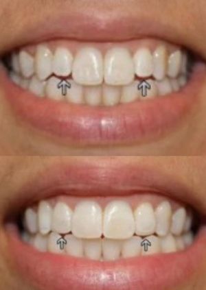 Before and after images of dental bonding treatment, showcasing the improvement of tooth gaps and shape with Dental Bondings in NYC.