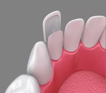 3D illustration showing the application of a dental veneer to a tooth, demonstrating how veneers improve aesthetics and function.